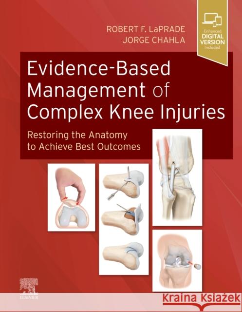 Evidence-Based Management of Complex Knee Injuries: Restoring the Anatomy to Achieve Best Outcomes Laprade, Robert F. 9780323713108 ELSEVIER HS8A - książka
