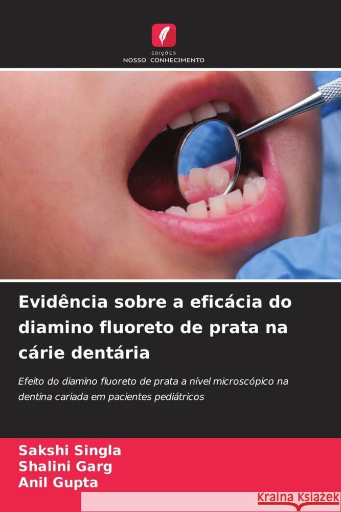 Evid?ncia sobre a efic?cia do diamino fluoreto de prata na c?rie dent?ria Sakshi Singla Shalini Garg Anil Gupta 9786208153700 Edicoes Nosso Conhecimento - książka