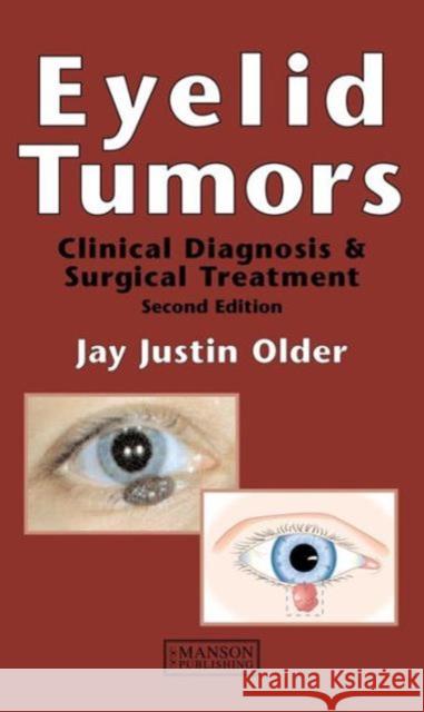 Eyelid Tumors  9781840760293 MANSON PUBLISHING LTD - książka