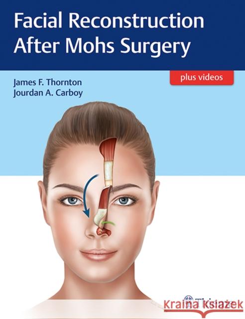 Facial Reconstruction After Mohs Surgery James F. Thornton Jourdan A. Carboy 9781626237346 Thieme Medical Publishers - książka
