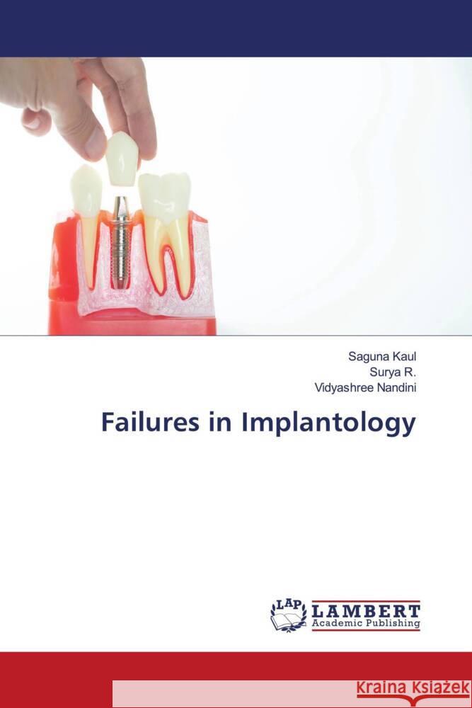 Failures in Implantology Kaul, Saguna, R., Surya, Nandini, Vidyashree 9786206737452 LAP Lambert Academic Publishing - książka