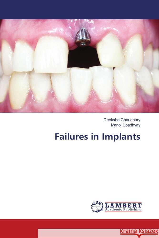 Failures in Implants Chaudhary, Deeksha, Upadhyay, Manoj 9786206179931 LAP Lambert Academic Publishing - książka