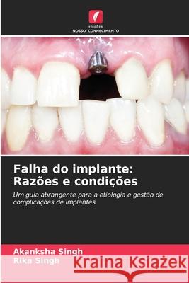Falha do implante: Razões e condições Singh, Akanksha, Singh, Rika 9786207170029 Edições Nosso Conhecimento - książka