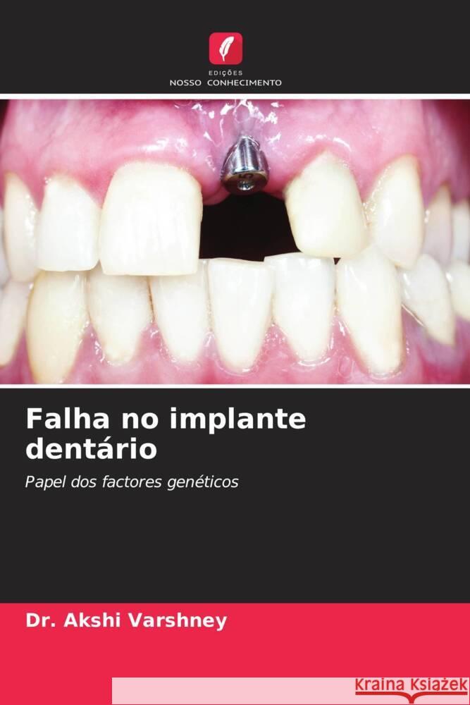 Falha no implante dent?rio Akshi Varshney 9786207139682 Edicoes Nosso Conhecimento - książka