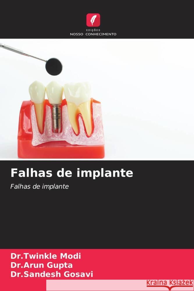 Falhas de implante Dr Twinkle Modi Dr Arun Gupta Dr Sandesh Gosavi 9786207430574 Edicoes Nosso Conhecimento - książka