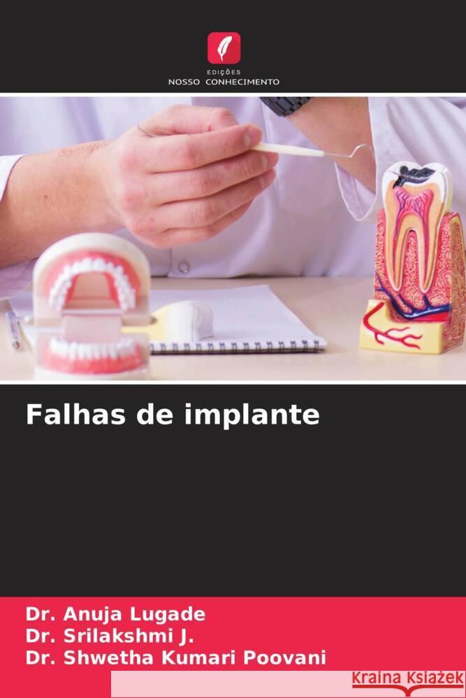Falhas de implante Anuja Lugade Srilakshmi J Shwetha Kumari Poovani 9786207967421 Edicoes Nosso Conhecimento - książka