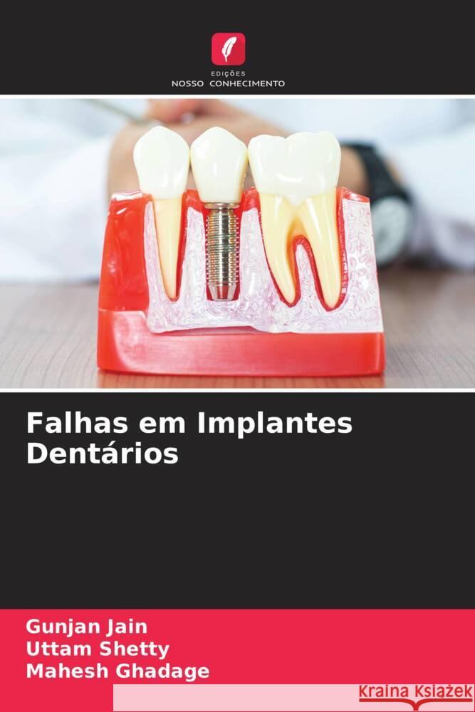 Falhas em Implantes Dentários Jain, Gunjan, Shetty, Uttam, Ghadage, Mahesh 9786205065655 Edições Nosso Conhecimento - książka