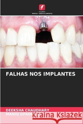 Falhas Nos Implantes Deeksha Chaudhary Manoj Upadhyay  9786206083948 Edicoes Nosso Conhecimento - książka