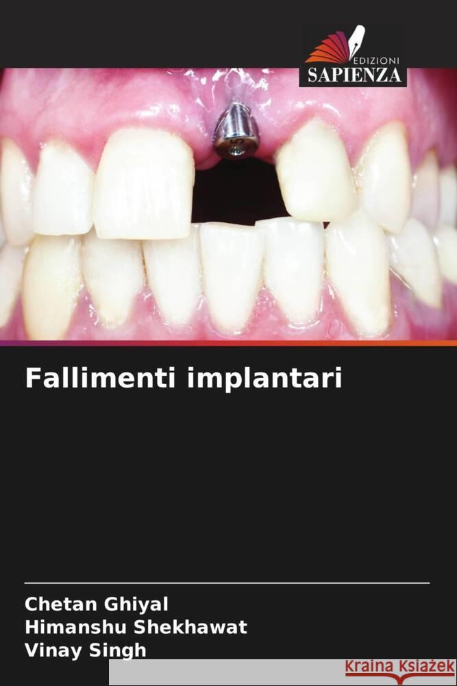 Fallimenti implantari Ghiyal, Chetan, Shekhawat, Himanshu, Singh, Vinay 9786208387198 Edizioni Sapienza - książka