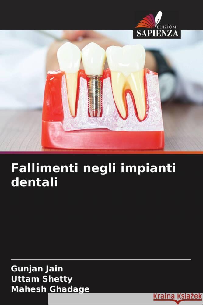 Fallimenti negli impianti dentali Jain, Gunjan, Shetty, Uttam, Ghadage, Mahesh 9786205065709 Edizioni Sapienza - książka