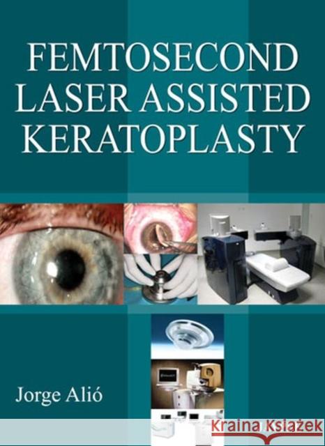 Femtosecond Laser Assisted Keratoplasty Jorge L Alio 9789350905098  - książka