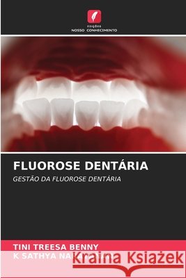 FLUOROSE DENTÁRIA Benny, Tini Treesa, Narayanan, K Sathya 9786200712394 Edições Nosso Conhecimento - książka