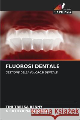 FLUOROSI DENTALE Benny, Tini Treesa, Narayanan, K Sathya 9786200712288 Edizioni Sapienza - książka