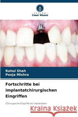 Fortschritte bei implantatchirurgischen Eingriffen Rahul Shah Pooja Mishra 9786207635214 Verlag Unser Wissen - książka