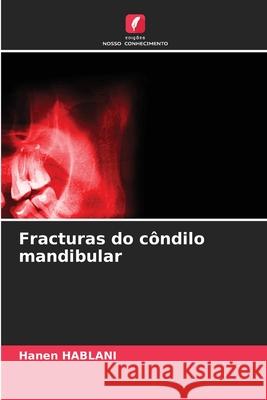 Fracturas do côndilo mandibular HABLANI, Hanen 9786209044052 Edições Nosso Conhecimento - książka
