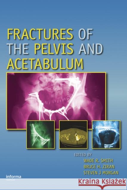 Fractures of the Pelvis and Acetabulum Wade Smith Smith & Smith                            Wade Smith 9780824728465 Informa Healthcare - książka