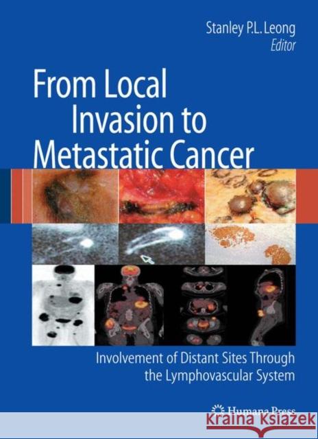 From Local Invasion to Metastatic Cancer: Involvement of Distant Sites Through the Lymphovascular System Leong, Stanley P. L. 9781603270861 Humana Press - książka