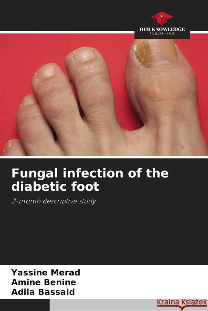 Fungal infection of the diabetic foot Merad, Yassine, Benine, Amine, Bassaid, Adila 9786206192046 Our Knowledge Publishing - książka