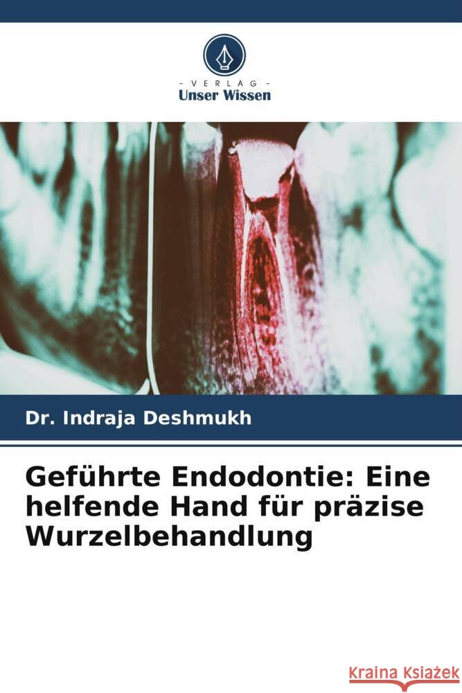 Gef?hrte Endodontie: Eine helfende Hand f?r pr?zise Wurzelbehandlung Indraja Deshmukh 9786208122003 Verlag Unser Wissen - książka