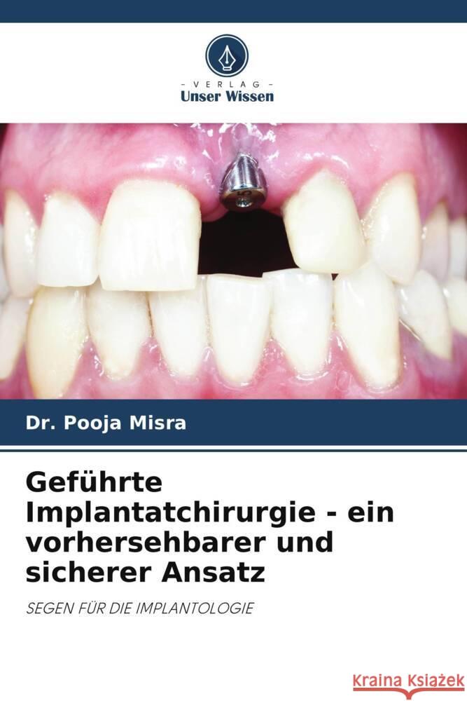 Geführte Implantatchirurgie - ein vorhersehbarer und sicherer Ansatz Misra, Dr. Pooja 9786205164754 Verlag Unser Wissen - książka
