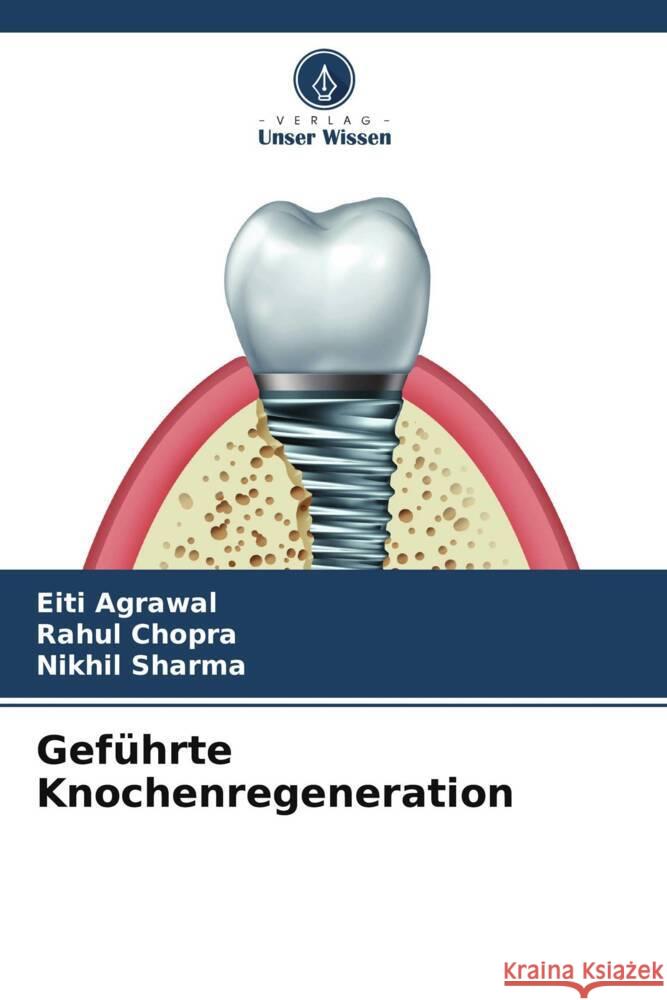 Geführte Knochenregeneration Agrawal, Eiti, Chopra, Rahul, Sharma, Nikhil 9786204820842 Verlag Unser Wissen - książka