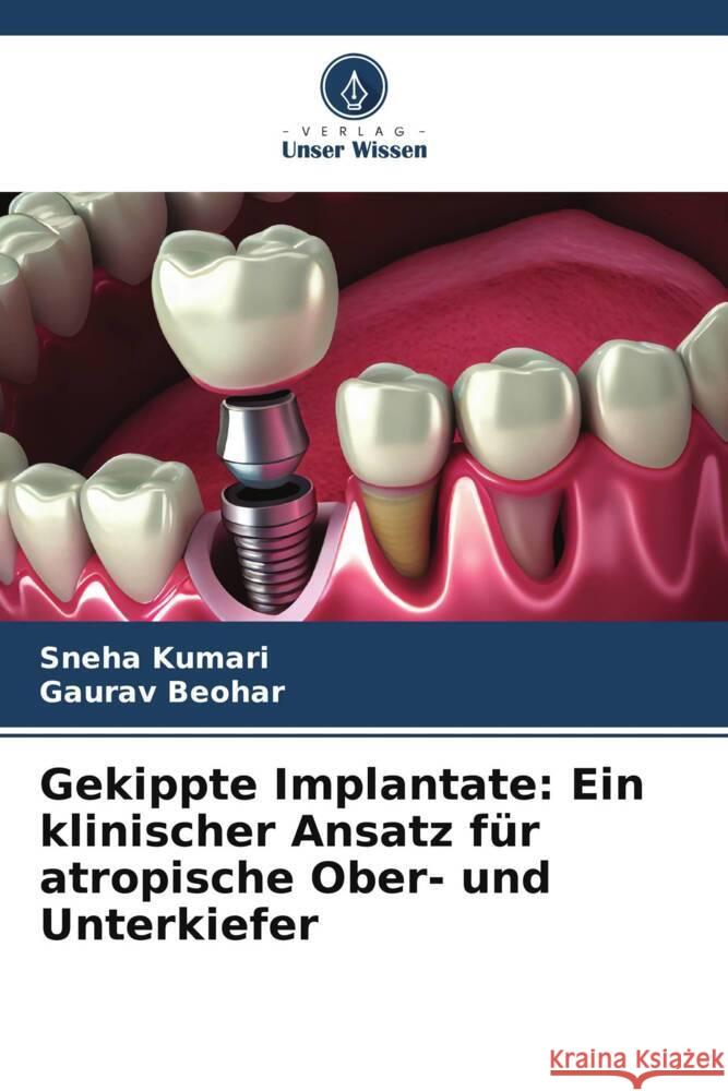 Gekippte Implantate: Ein klinischer Ansatz f?r atropische Ober- und Unterkiefer Sneha Kumari Gaurav Beohar 9786206903710 Verlag Unser Wissen - książka