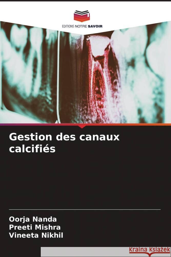 Gestion des canaux calcifiés Nanda, Oorja, Mishra, Preeti, Nikhil, Vineeta 9786208197483 Editions Notre Savoir - książka