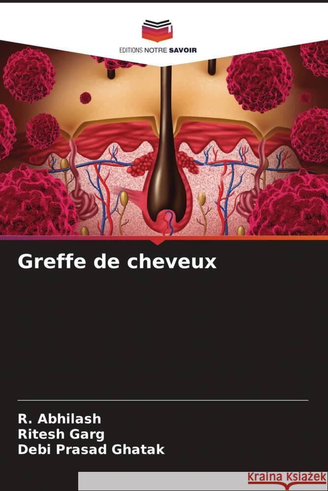 Greffe de cheveux R. Abhilash Ritesh Garg Debi Prasad Ghatak 9786206994916 Editions Notre Savoir - książka