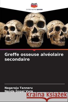 Greffe osseuse alvéolaire secondaire Tanneru, Nagaraju, Vura, Nanda Gopal 9786208724757 Editions Notre Savoir - książka