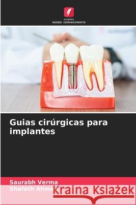 Guias cir?rgicas para implantes Saurabh Verma Shafath Ahmed 9786207663613 Edicoes Nosso Conhecimento - książka