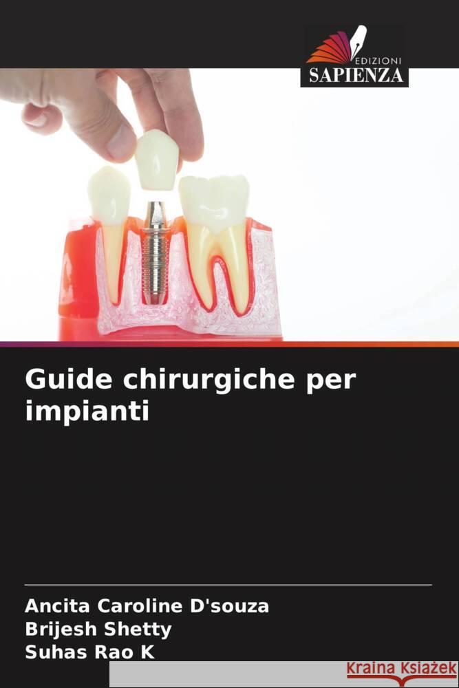 Guide chirurgiche per impianti Ancita Caroline D'Souza Brijesh Shetty Suhas Rao K 9786208075682 Edizioni Sapienza - książka