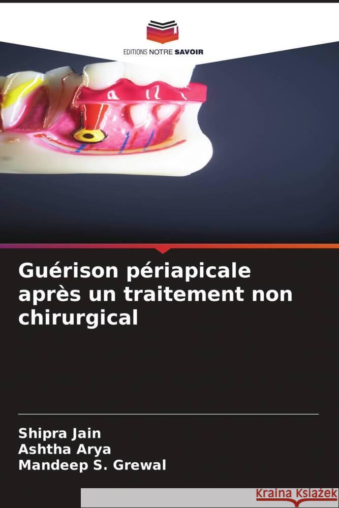 Gu?rison p?riapicale apr?s un traitement non chirurgical Shipra Jain Ashtha Arya Mandeep S. Grewal 9786207356324 Editions Notre Savoir - książka