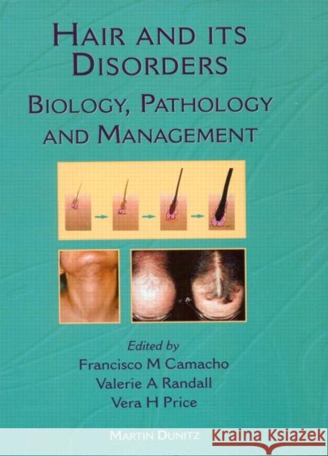 Hair and Its Disorders: Biology, Pathology and Management Camacho, Francisco M. 9781853177996 Taylor & Francis Group - książka