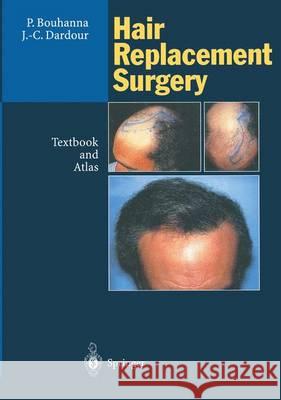 Hair Replacement Surgery: Textbook and Atlas Bouhanna, Pierre 9783642796142 Springer - książka