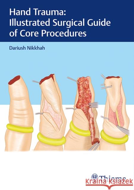 Hand Trauma: Illustrated Surgical Guide of Core Procedures Dariush Nikkhah 9783132414266 Thieme Medical Publishers - książka
