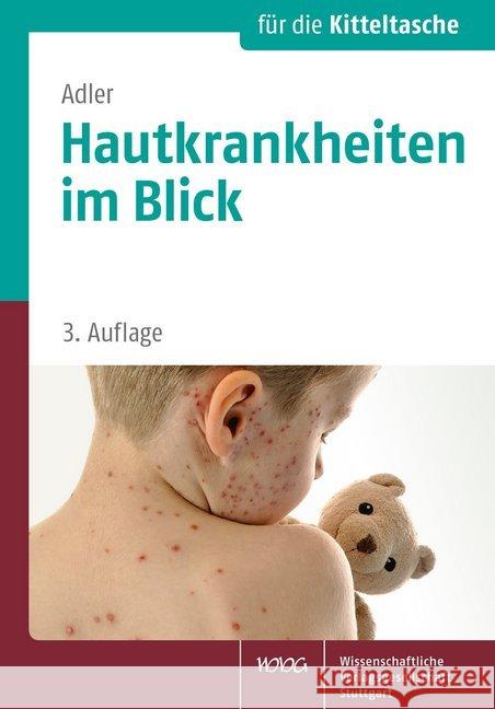 Hautkrankheiten im Blick : Ein Fotoatlas Adler, Yael 9783804732476 Wissenschaftliche Verlagsgesellschaft - książka