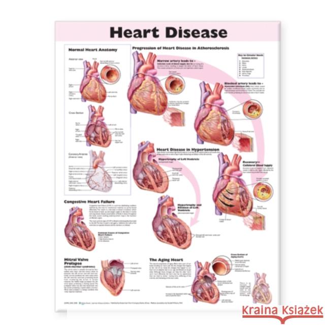 Heart Disease Anatomical Chart  Anatomical Chart Company 9780781773379  - książka