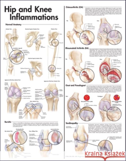 Hip and Knee Inflammations Anatomical Chart  Anatomical Chart Company 9780781773478  - książka