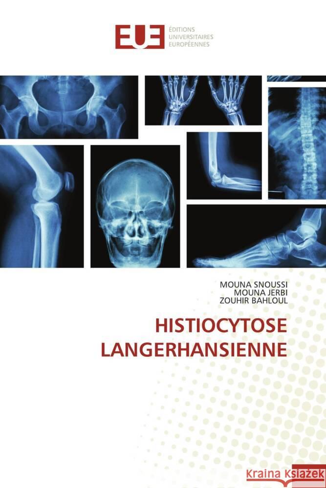 HISTIOCYTOSE LANGERHANSIENNE SNOUSSI, MOUNA, Jerbi, Mouna, Bahloul, Zouhir 9786206698586 Éditions universitaires européennes - książka