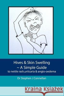 Hives & Skin Swelling A Simple Guide: to nettle rash, urticaria & angio-oedema Connellan, Stephen J. 9781477439340 Createspace - książka