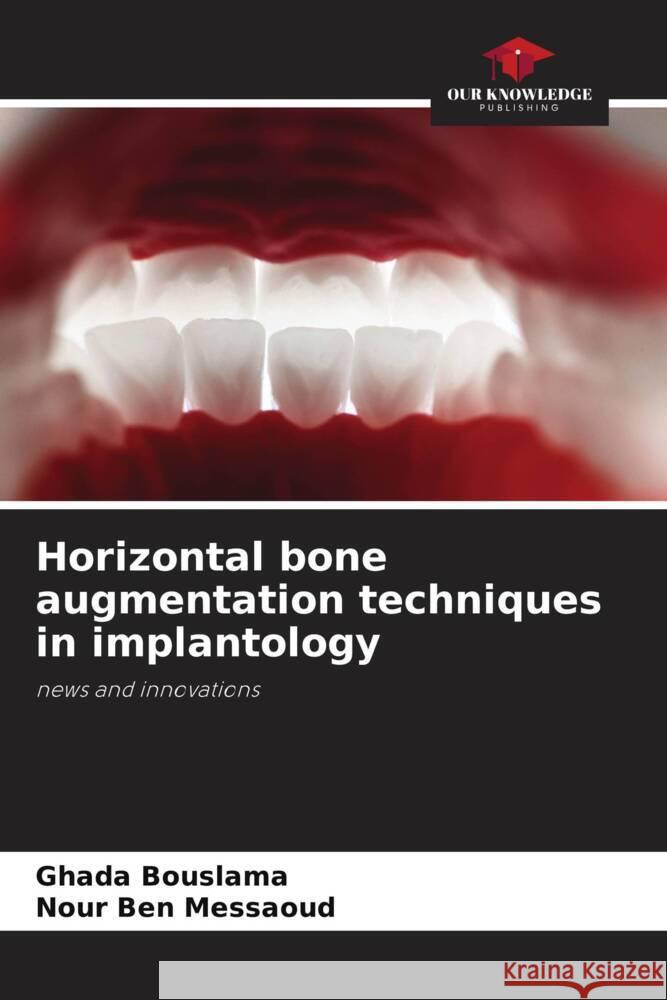 Horizontal bone augmentation techniques in implantology Bouslama, Ghada, Ben Messaoud, Nour 9786208253592 Our Knowledge Publishing - książka