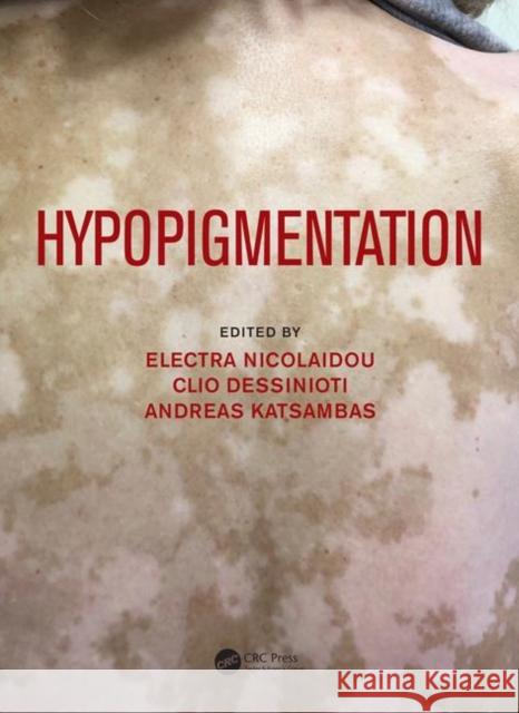 Hypopigmentation Electra Nicolaidou Clio Dessinioti Andreas Katsambas 9781138505230 CRC Press - książka