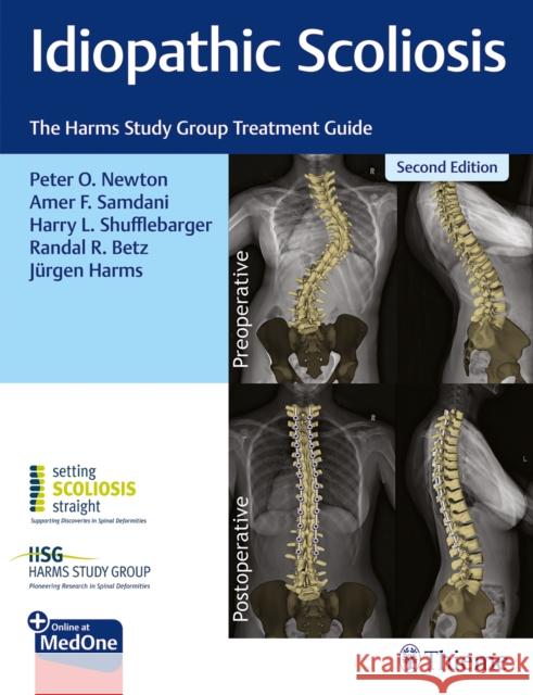 Idiopathic Scoliosis: The Harms Study Group Treatment Guide Peter Newton Amer Samdani Harry Shufflebarger 9781684200559 Thieme Medical Publishers - książka