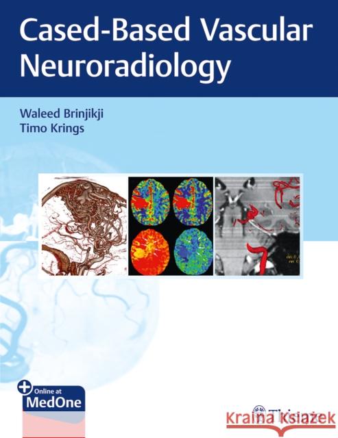 Imaging in Neurovascular Disease: A Case-Based Approach Brinjikji, Waleed 9781684200535 Thieme Medical Publishers - książka