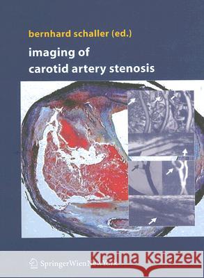 Imaging of Carotid Artery Stenosis Bernhard Schaller 9783211323328 Springer - książka