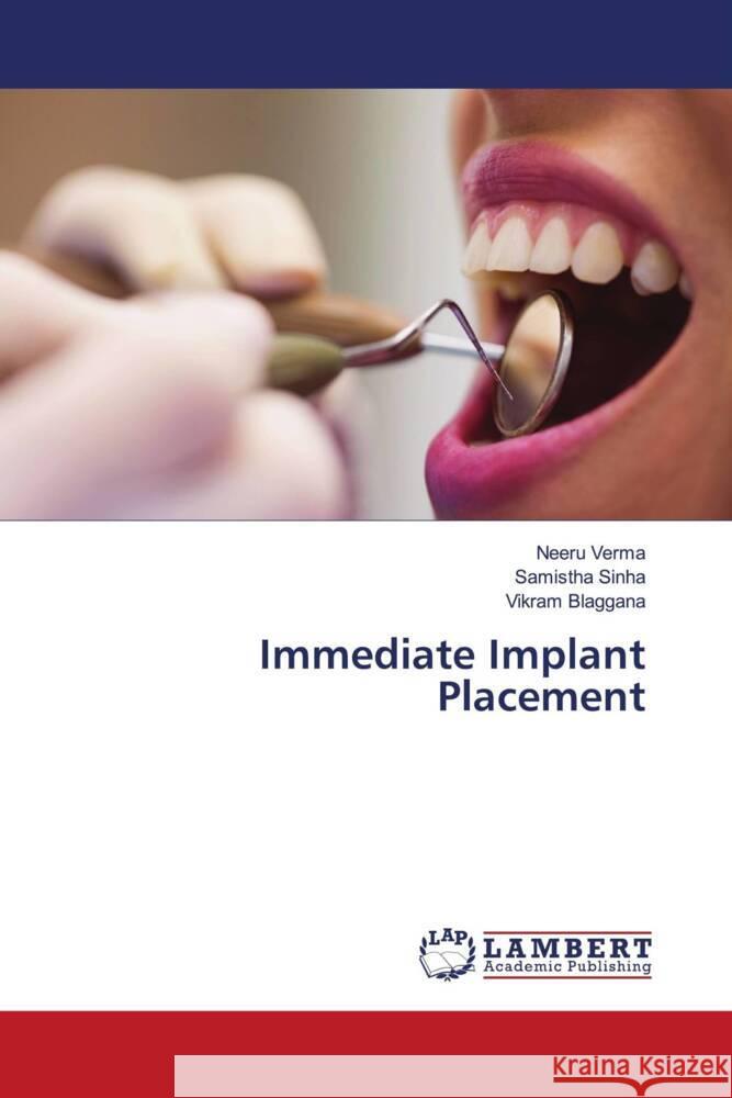 Immediate Implant Placement Verma, Neeru, Sinha, Samistha, Blaggana, Vikram 9786206789802 LAP Lambert Academic Publishing - książka