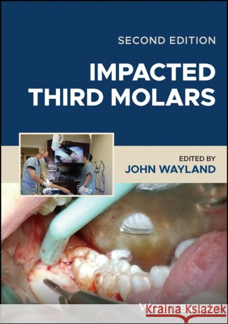 Impacted Third Molars Wayland 9781119930303 John Wiley and Sons Ltd - książka