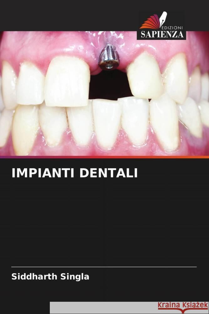 IMPIANTI DENTALI Singla, Siddharth 9786204793870 Edizioni Sapienza - książka