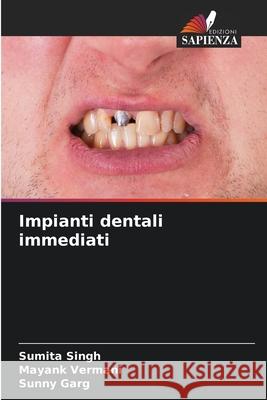Impianti dentali immediati Singh, Sumita, Vermani, Mayank, Garg, Sunny 9786208765132 Edizioni Sapienza - książka