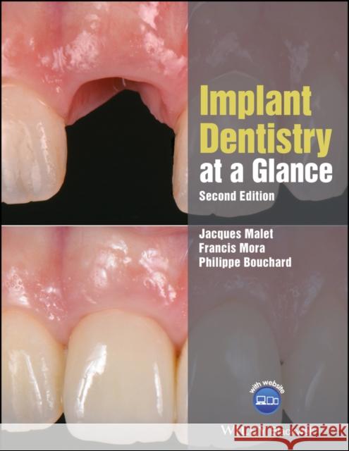 Implant Dentistry at a Glance Jacques Malet Francis Mora Philippe Bouchard 9781119292609 Wiley-Blackwell - książka